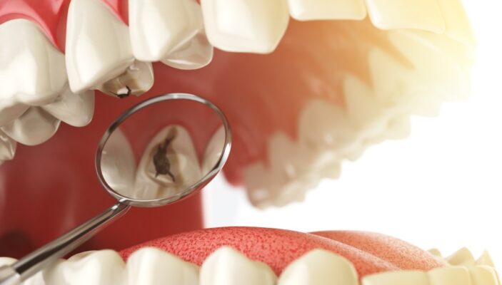 Răng sứ bị sâu do nhét thức ăn – Dấu hiệu bạn không nên bỏ qua