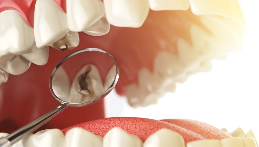 Răng sứ bị sâu do nhét thức ăn – Dấu hiệu bạn không nên bỏ qua