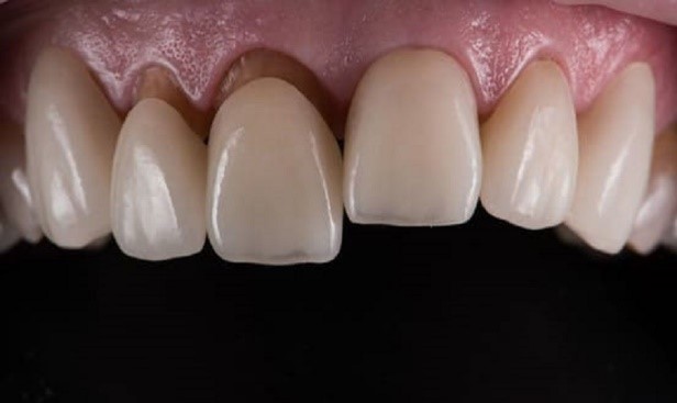 Răng sứ bị viêm lợi có cần làm lại không