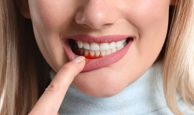 Răng sứ bị viêm lợi có cần làm lại không