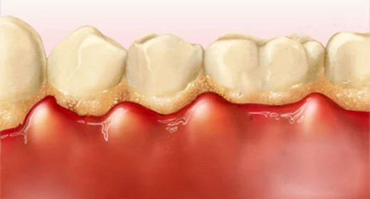 Thuốc trị viêm lợi răng sứ có thật sự hiệu quả Cảnh báo khi tự ý dùng tại nhà