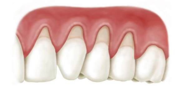 Triệu chứng nhận biết viêm lợi do răng sứ