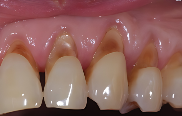 Ảnh hưởng của tình trạng răng bị tụt lợi hở kẽ