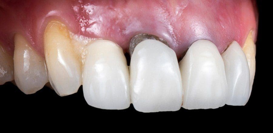 Nguyên nhân khiến răng sứ bị tụt lợi hở kẽ