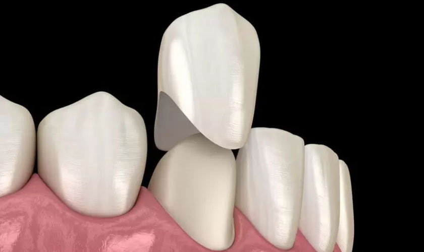 Quy trình làm lại răng sứ có đau không là câu hỏi được nhiều người quan tâm