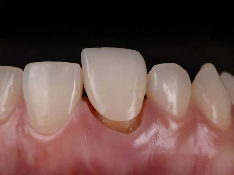 Răng sứ bị hở kẽ gây ảnh hưởng đến sinh hoạt hàng ngày