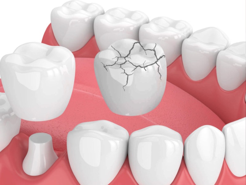 Răng sứ bị nứt, vỡ là nguyên nhân gây ra tình trạng hôi miệng răng sứ dắt thức ăn