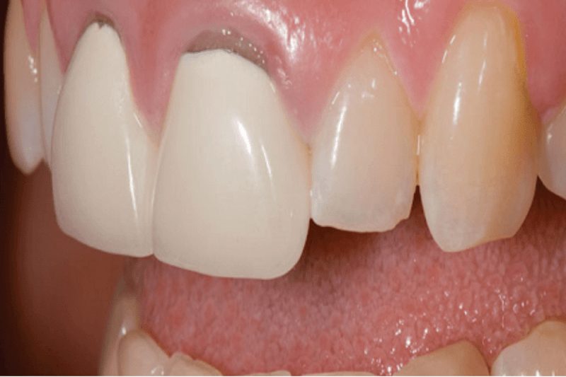 Răng sứ hở kẽ có nên làm lại Những rủi ro nếu bạn chậm xử lý