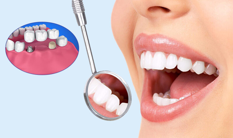 Bọc răng sứ giá tốt nhất trắng đẹp tự nhiên không đau 1 Bọc răng sứ giá tốt nhất trắng đẹp tự nhiên không đau