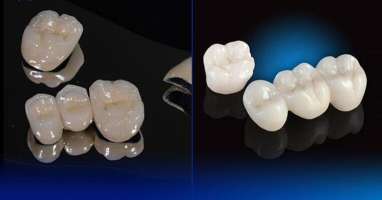 Làm răng sứ nhanh có bền không và nên thực hiện ở đâu uy tín để đảm bảo độ bền lâu dài?