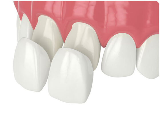 dan su veneer 2 rang cua 2