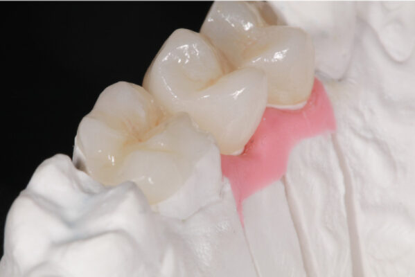 hau qua cua boc rang su co hai khong