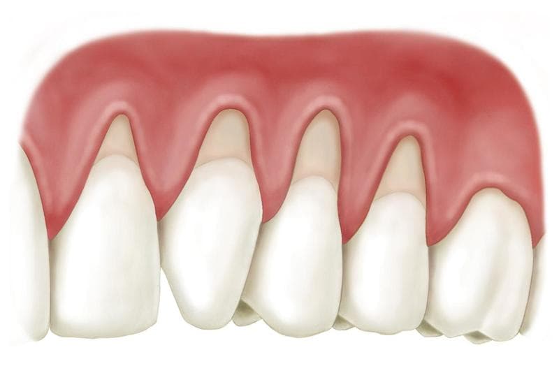 Trồng răng sứ giá tốt nhất bao nhiêu tiền? Những yếu tố ảnh hưởng đến chi phí