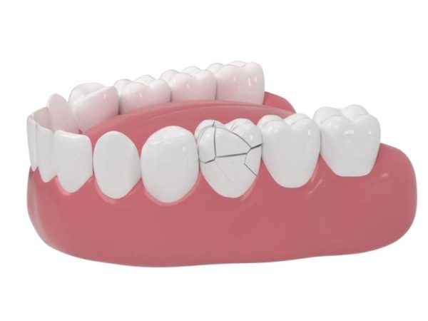 mai rang boc su 3 600x450 1