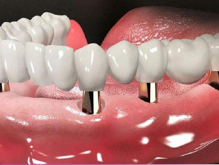 Bí quyết cách chọn răng sứ giá tốt nhất không phải ai cũng biết