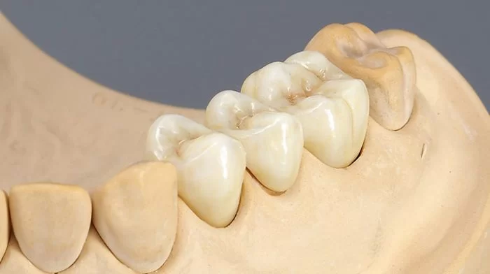 Labo răng sứ nhận gia công răng sứ - Bí quyết tạo nên hàm răng tự nhiên như thật