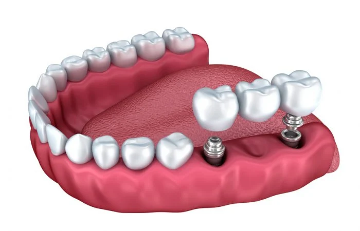 cam rang implant gia bao nhieu e1537860965259 1