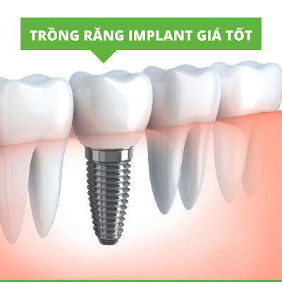 cay ghep implant gia bao nhieu 1