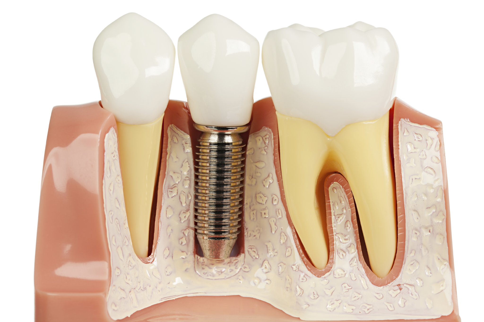 Bí quyết chọn dịch vụ trồng răng implant giá hợp lý mà vẫn đảm bảo chất lượng