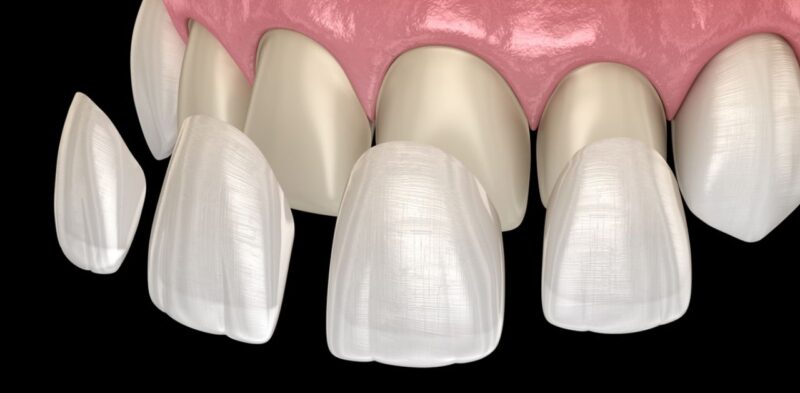 dan su veneer la gi 2