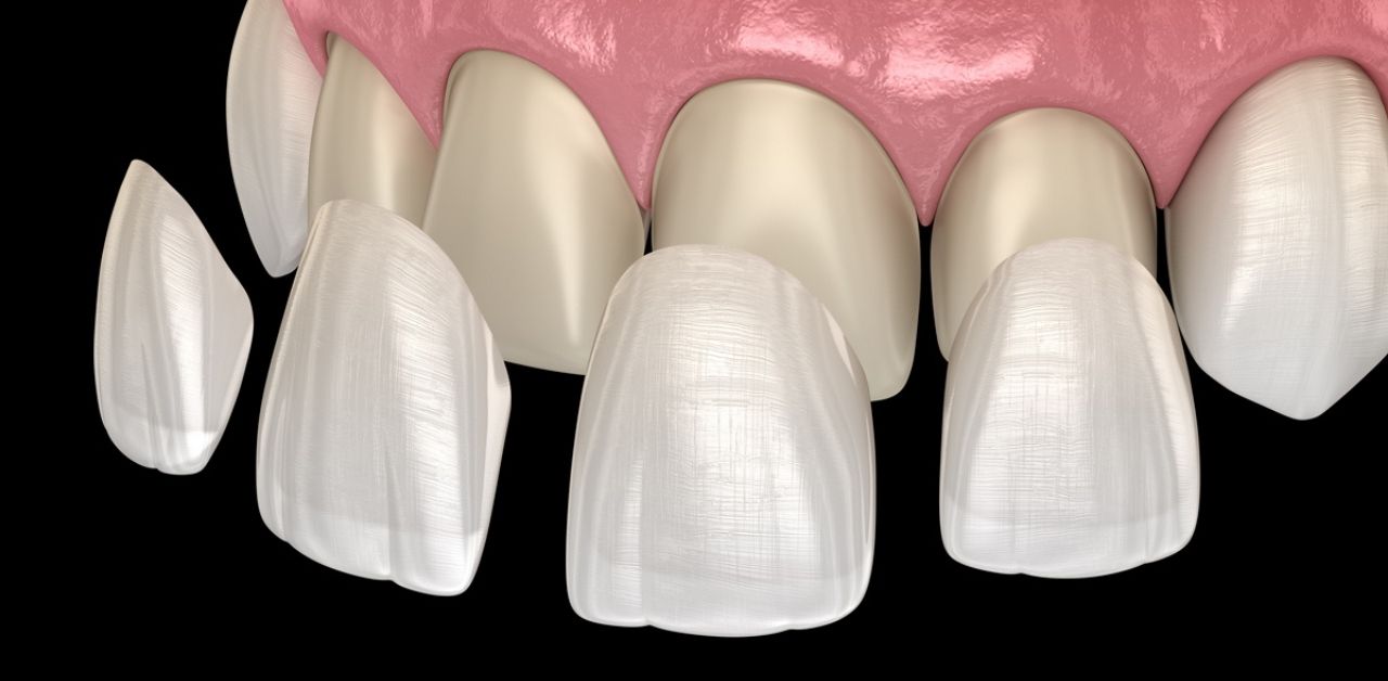 dan su veneer la gi 2