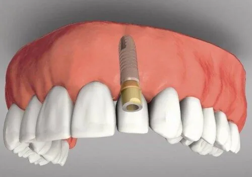 gia trong rang implant bao nhieu la hop ly