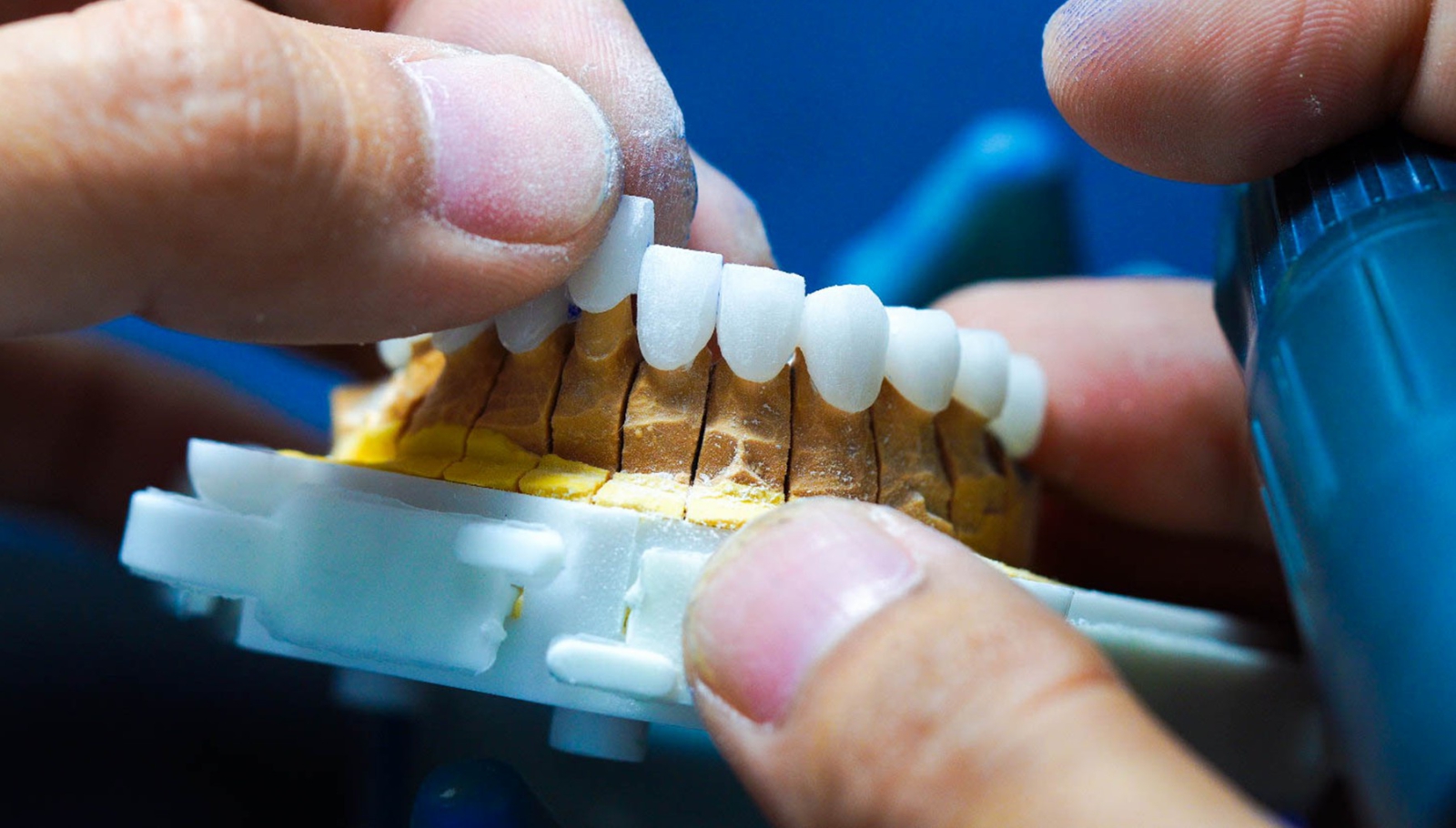 Labo răng sứ chất lượng cao – Giải pháp hoàn hảo cho nụ cười bền đẹp