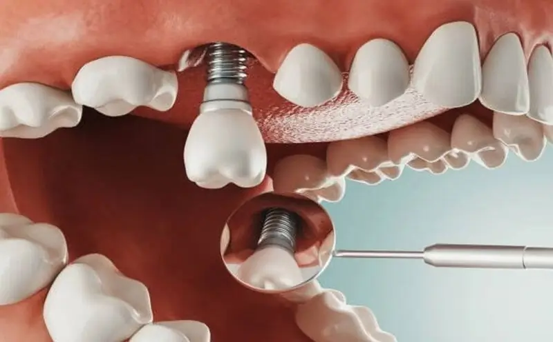 Ai nên trồng răng implant để đảm bảo ăn nhai và thẩm mỹ lâu dài