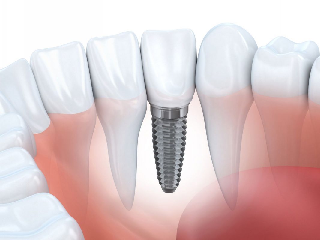 trong implant 1
