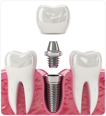 Ưu điểm vượt trội của trồng răng implant trong ngày bạn nên biết
