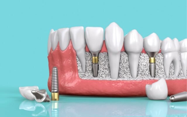 trong rang implant 1