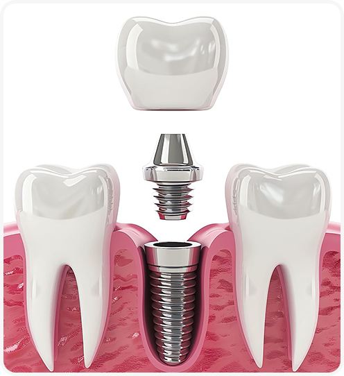 Ưu điểm vượt trội của trồng răng implant trong ngày bạn nên biết