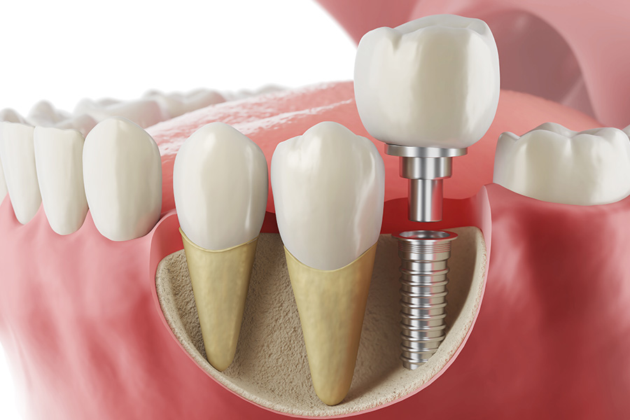 Ai nên trồng răng implant để đảm bảo ăn nhai và thẩm mỹ lâu dài