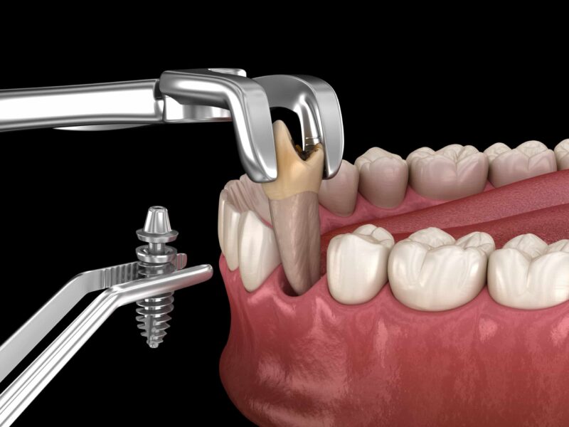 Ưu điểm vượt trội của trồng răng implant trong ngày bạn nên biết