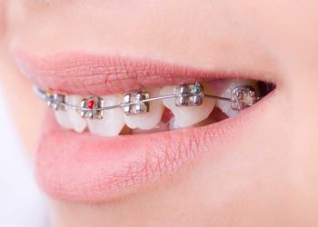 Nắm rõ các bước trồng răng Implant để yên tâm trước khi thực hiện