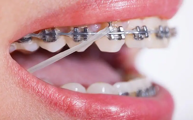 Nắm rõ các bước trồng răng Implant để yên tâm trước khi thực hiện