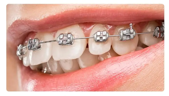 Bảng giá trồng răng Implant mới nhất và những yếu tố ảnh hưởng đến chi phí 1 Bảng giá trồng răng Implant mới nhất và những yếu tố ảnh hưởng đến chi phí