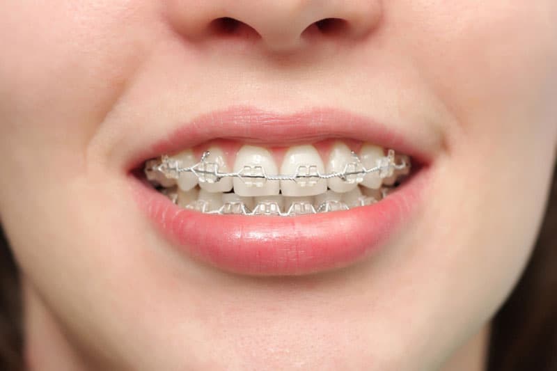 Bảng giá trồng răng Implant mới nhất và những yếu tố ảnh hưởng đến chi phí 2 Bảng giá trồng răng Implant mới nhất và những yếu tố ảnh hưởng đến chi phí