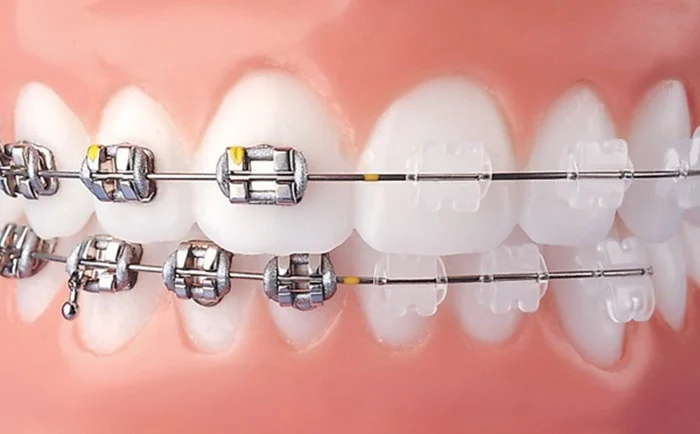 Bảng giá trồng răng Implant mới nhất và những yếu tố ảnh hưởng đến chi phí 3 Bảng giá trồng răng Implant mới nhất và những yếu tố ảnh hưởng đến chi phí