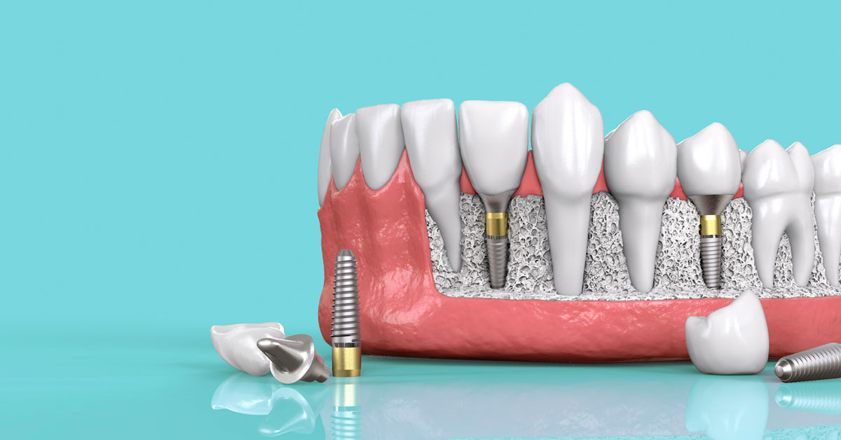 Sự thật về trồng răng Implant có tốt không mà nhiều người quan tâm